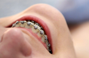 L’orthodontie autoligaturante