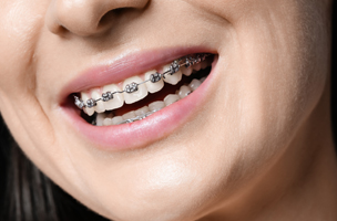 L’orthodontie multi-attaches